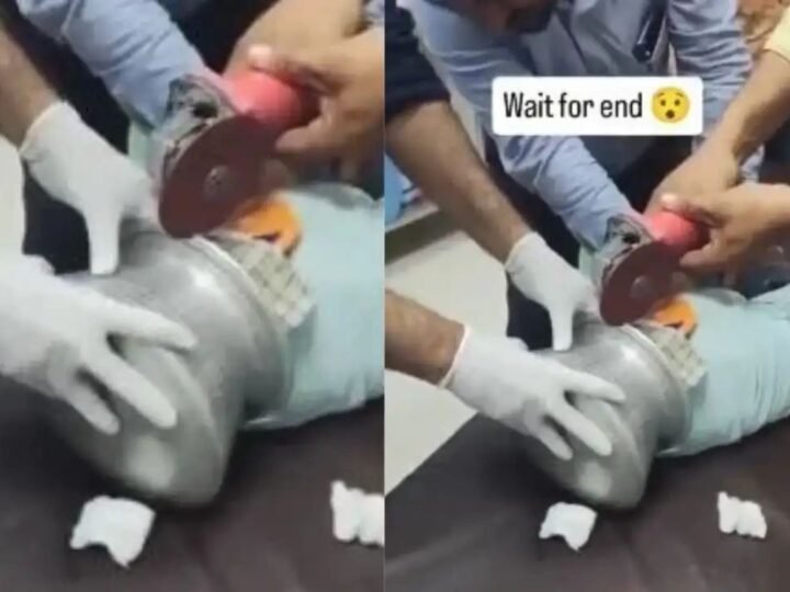 बच्चे के सिर में फंसा पतीला, कटर से निकालने का वीडियो वायरल