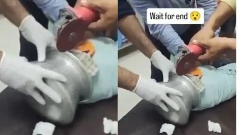 बच्चे के सिर में फंसा पतीला, कटर से निकालने का वीडियो वायरल