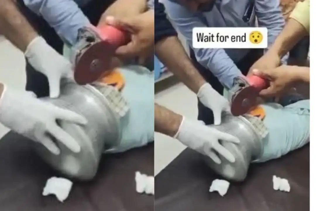 बच्चे के सिर में फंसा पतीला, कटर से निकालने का वीडियो वायरल